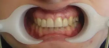 after-image
