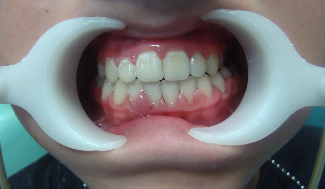 after-image