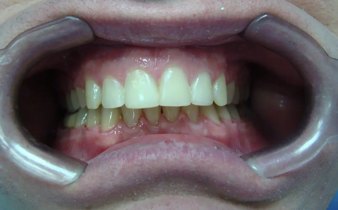after-image