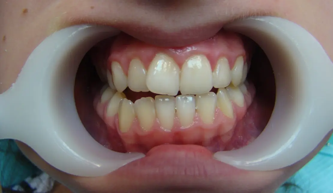 before-image