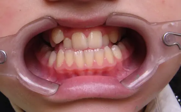 before-image