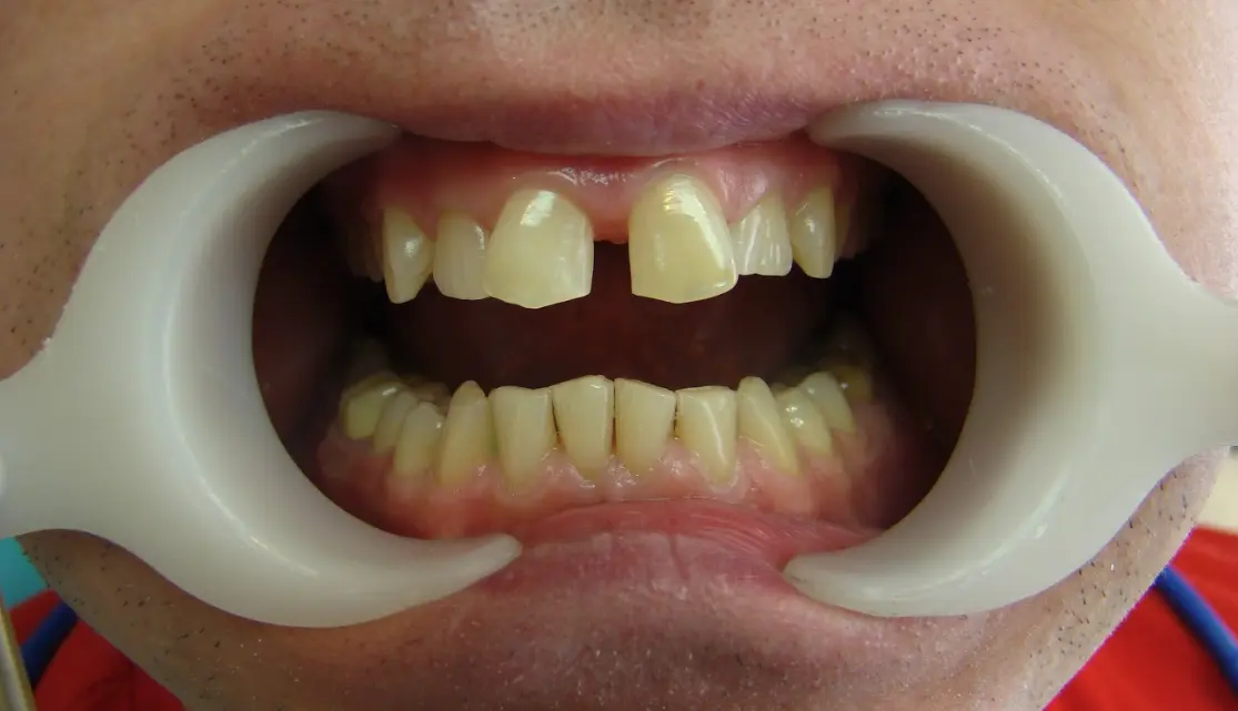 before-image