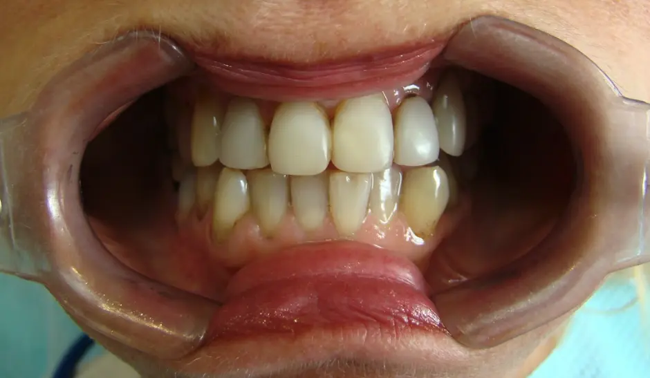 before-image